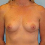 Patient 19 Before Breast Augmentation Front View