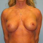 Patient 16 Before Breast Augmentation Front View