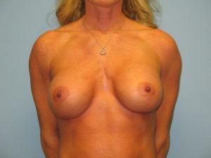 Patient 16 Before Breast Augmentation Front View