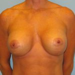 Patient 16 After Breast Augmentation Front View