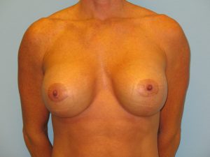 Patient 16 After Breast Augmentation Front View