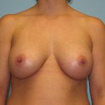Patient 17 After Breast Augmentation Front View