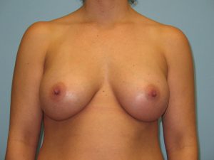 Patient 17 After Breast Augmentation Front View