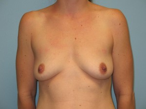 Patient J Before Breast Reduction Front View