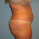 Patient 6 Before Abdominoplasty Right Side View