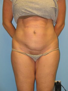Patient 7 Before Abdominoplasty Front View