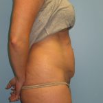 Patient 7 Before Abdominoplasty Right Side View