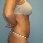 Patient 7 After Abdominoplasty Right Side View