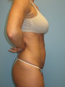 Patient 7 After Abdominoplasty Right Side View