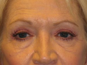 Patient 5 Before Blepharoplasty