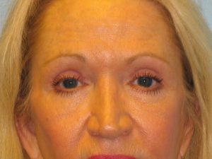 Patient 5 After Blepharoplasty