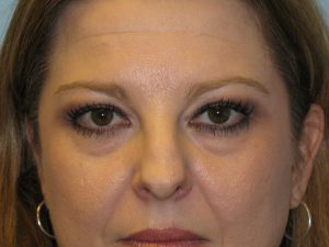 Patient 7 Before Blepharoplasty