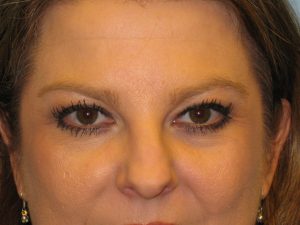 Patient 7 After Blepharoplasty