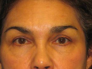 Patient 8 After Blepharoplasty