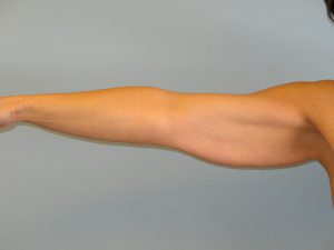 Patient 1 Before Brachioplasty Left Arm