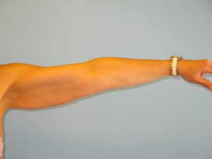 Patient 1 Before Brachioplasty Right Arm