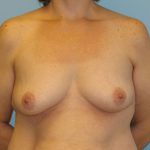 Patient 12 Before Breast Augmentation Front View