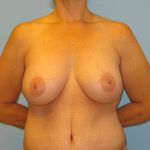 Patient 12 After Breast Augmentation Front View