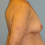 Patient 12 Before Breast Augmentation Right View