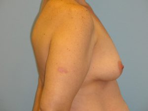 Patient 12 Before Breast Augmentation Right View