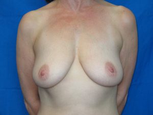 Patient 14 Before Breast Augmentation Front View
