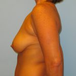 Patient 11 Before Breast Augmentation Left View