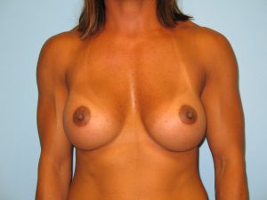 Patient 15 Before Breast Augmentation Front View