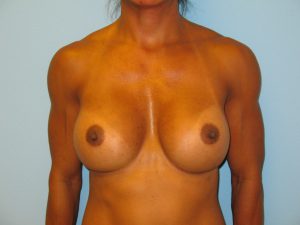 Patient 15 After Breast Augmentation Front View