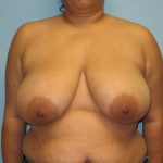 Patient 10 Before Breast Reduction Front View