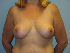 Patient 17 After Breast Reduction Front View