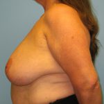 Patient 19 Before Breast Reduction Left View