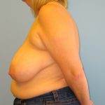 Patient 8 Before Breast Reduction Left View