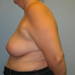 Patient 8 After Breast Reduction Left View