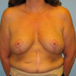 Patient 9 After Breast Reduction Front View