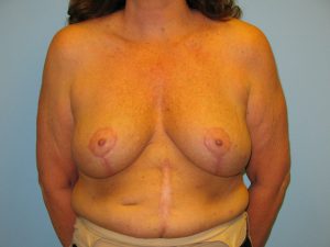 Patient 9 After Breast Reduction Front View