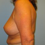 Patient 9 After Breast Reduction Left View