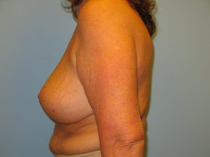 Patient 9 After Breast Reduction Left View