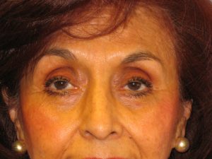 Patient 2 After Blepharoplasty