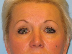 Patient 3 Before Blepharoplasty