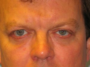Patient 4 After Blepharoplasty
