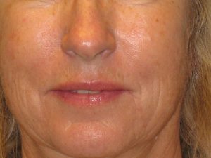 Patient 3 After Facial Surgery
