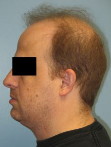 Patient 5 After Facial Surgery