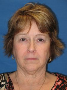 Patient 6 Before Facial Surgery Front View