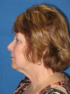 Patient 6 Before Facial Surgery Left Side View
