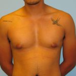 Patient 3 Before Gynecomastia Front View