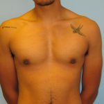 Patient 3 After Gynecomastia Front View