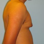 Patient 3 Before Gynecomastia Right Side View