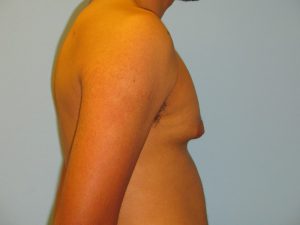 Patient 3 Before Gynecomastia Right Side View