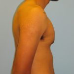 Patient 3 After Gynecomastia Right Side View