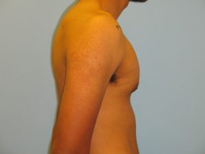 Patient 3 After Gynecomastia Right Side View